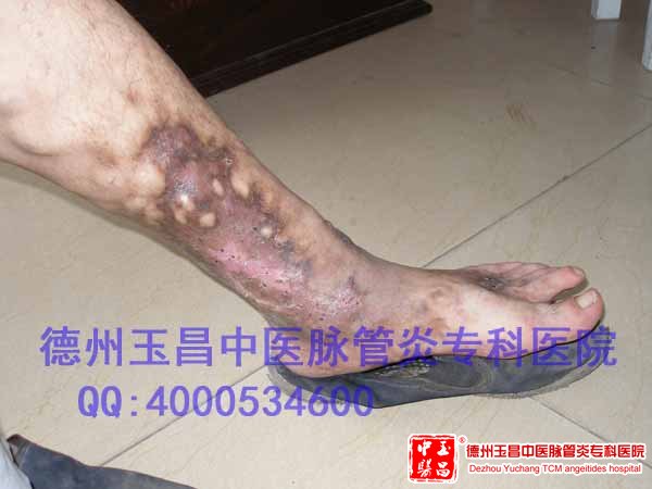 我院特制中药彻底治愈静脉炎